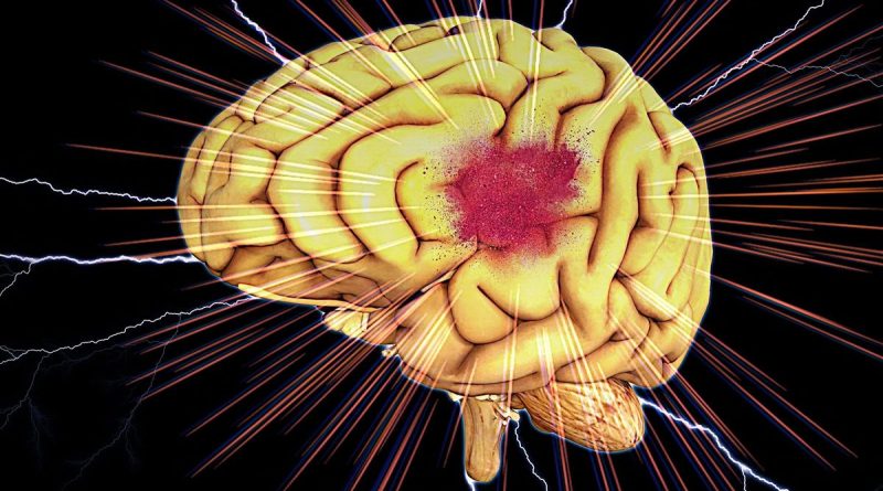 Une neurologue d'Amiens alerte sur le lien entre hypertension et AVC