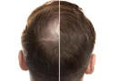 A sweet fix for baldness? Stevia compound boosts hair growth