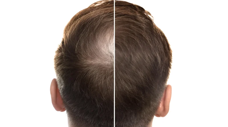 A sweet fix for baldness? Stevia compound boosts hair growth