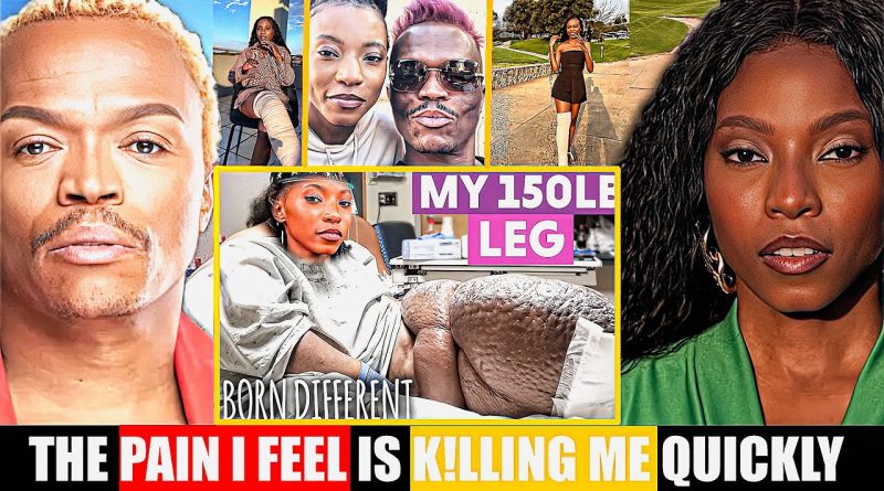 Bahumi révèle la lutte émouvante contre le lymphœdème