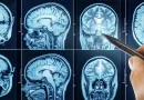 Poor sleep speeds brain aging and may raise dementia risk