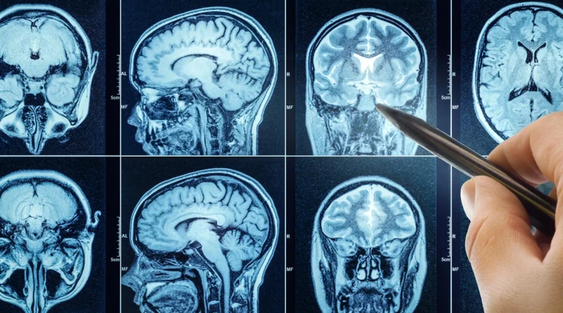 Poor sleep speeds brain aging and may raise dementia risk