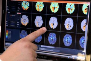 Journée mondiale de l’AVC : 160.000 personnes touchées chaque année en France, la plupart évitables.