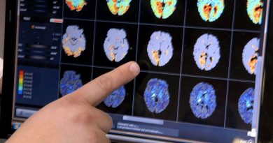 Journée mondiale de l’AVC : 160.000 personnes touchées chaque année en France, la plupart évitables.