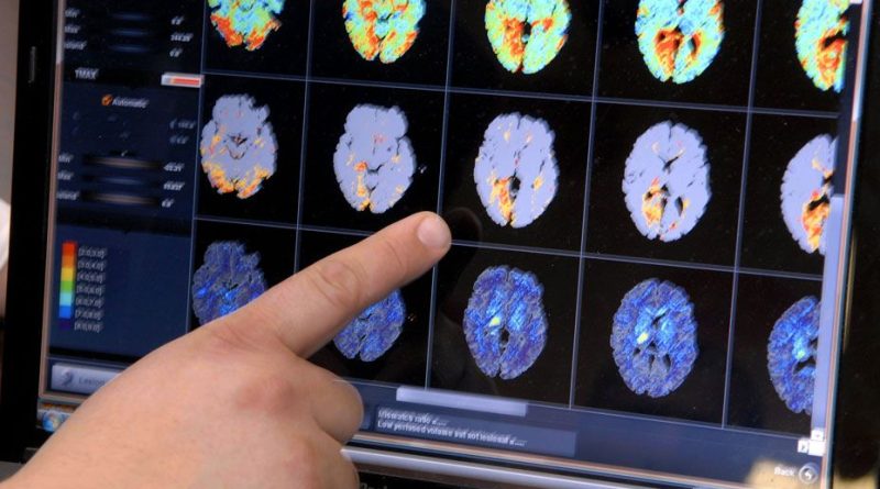 Journée mondiale de l’AVC : 160.000 personnes touchées chaque année en France, la plupart évitables.