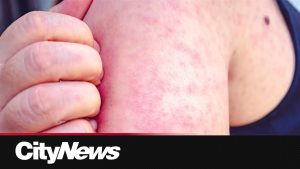 Le Canada perd son statut d'élimination de la rougeole
