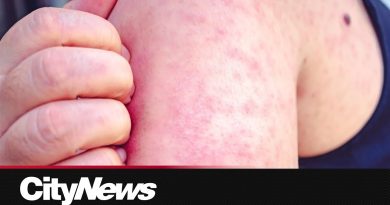 Le Canada perd son statut d'élimination de la rougeole