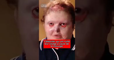 Célébrités dont la chirurgie a déformé le visage