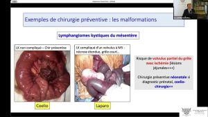 Chirurgie préventive en oncologie pédiatrique et préservation