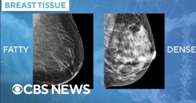 Des médecins utilisent l'IA pour évaluer le risque de cancer du sein