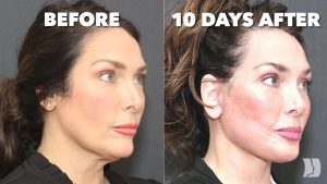 Des résultats époustouflants : guérison rapide et mâchoire bionique