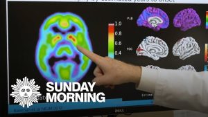 Essais cliniques prometteurs pour prévenir Alzheimer