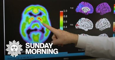 Essais cliniques prometteurs pour prévenir Alzheimer