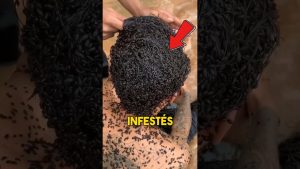 Insectes Étranges Découverts Dans Vos Cheveux !