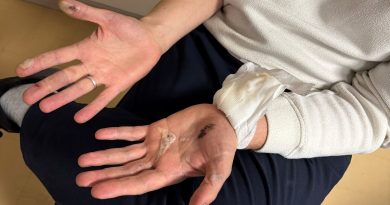 « J’ai vraiment eu peur » : gravement brûlé après l’explosion de sa batterie de cigarette électronique dans le RER