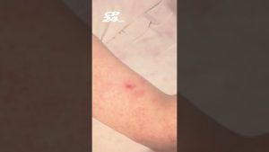 Le Canada perd son statut d'élimination de la rougeole après 30 ans