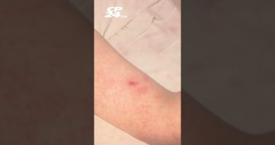 Le Canada perd son statut d'élimination de la rougeole après 30 ans