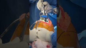 Le choix idéal : Chirurgie du genou robotisée avec Dr. Walecha