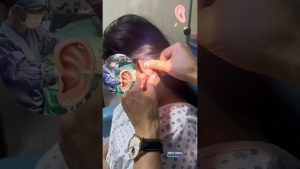Retrait de Kéloïdes de l'Oreille : Résultats Étonnants ! 💉