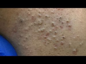 Routine de Soins du Visage : Traitement et Prévention des Boutons