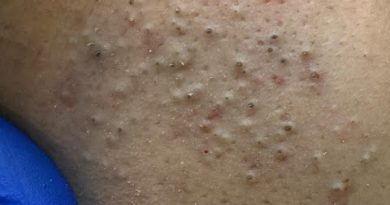 Routine de Soins du Visage : Traitement et Prévention des Boutons