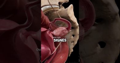 Tout savoir sur le syndrome SOPK : conseils et bien-être !