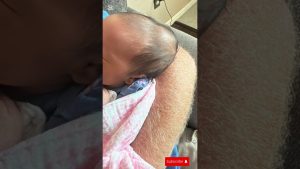 Un nouveau-né présente un céphalhématome : explications