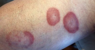 Granulome annulaire : symptômes, causes et options de traitement détaillées
