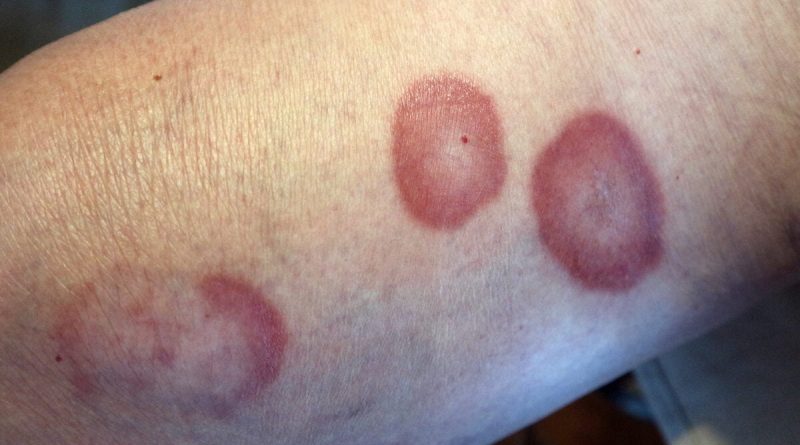 Granulome annulaire : symptômes, causes et options de traitement détaillées