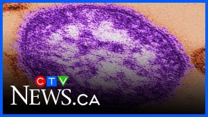 Le Canada perd son statut d'élimination de la rougeole