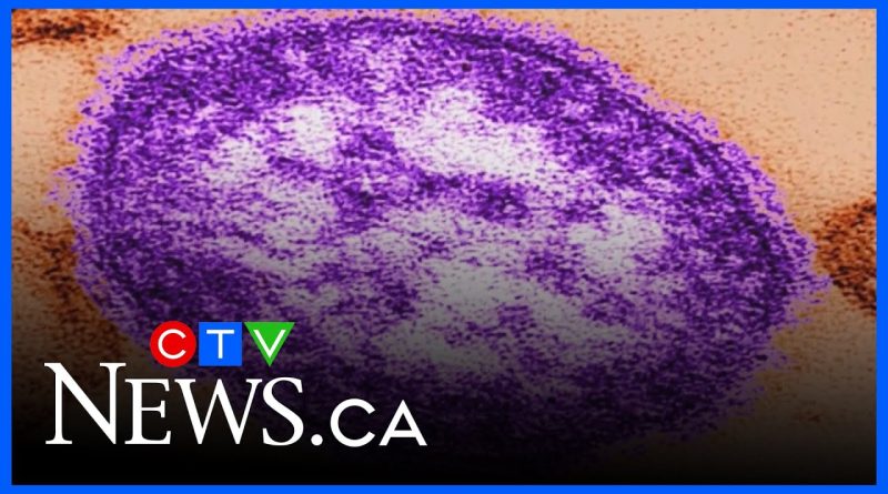 Le Canada perd son statut d'élimination de la rougeole