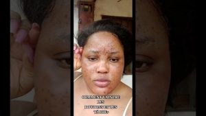 Vaincre boutons et taches : astuces et traitements efficaces