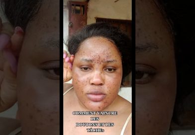 Vaincre boutons et taches : astuces et traitements efficaces