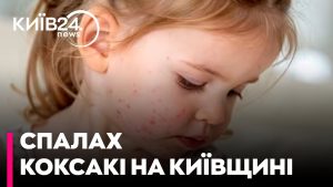 Virus Coxsackie à Kyiv : dangers et conseils d'Alia Mironenko