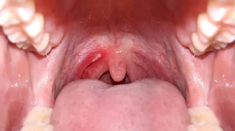 Une consommation quotidienne d'alcool pourrait augmenter le risque de cancer buccal