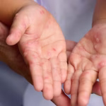 Un bébé décède de la scarlatine après une erreur médicale aux urgences