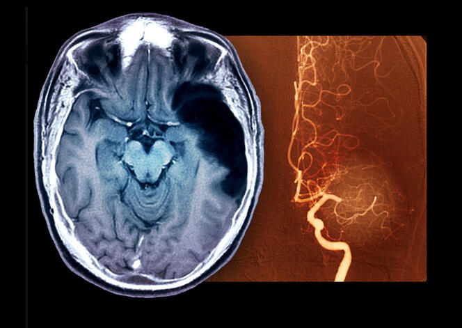 Images médicales d'un cerveau ayant subit un AVC ischémique