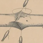 Le corps recomposé : l'évolution des premières greffes médicales