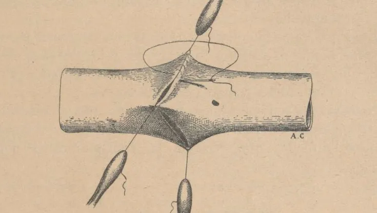 Le corps recomposé : l'évolution des premières greffes médicales