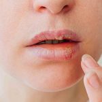 Bouton de fièvre : 10 informations essentielles sur l'herpès labial