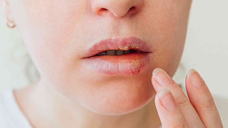 Bouton de fièvre : 10 informations essentielles sur l'herpès labial