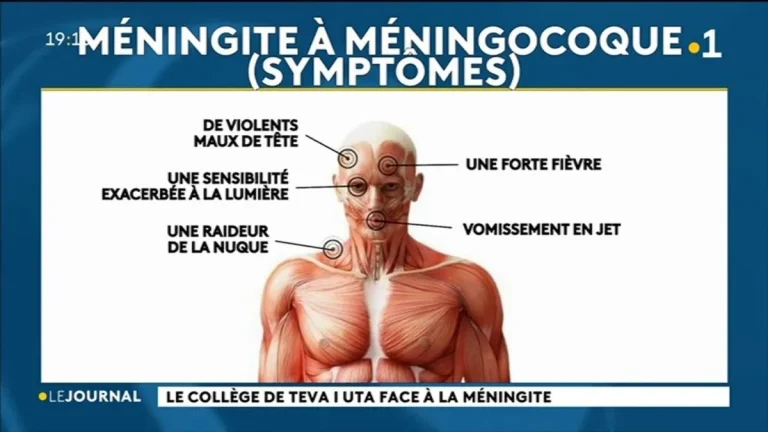 Cluster de méningites au Royaume-Uni, un cas de méningocoque à Papeete : vigilance face à une maladie rare mais foudroyante