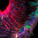 Alzheimer : identification de nouvelles cellules liées à l'apparition et à la progression