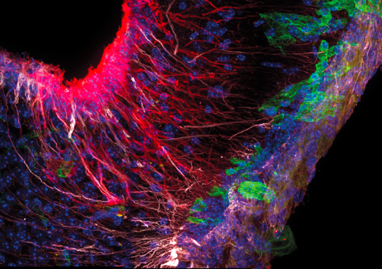 Alzheimer : identification de nouvelles cellules liées à l'apparition et à la progression
