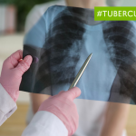 Hausse des cas de tuberculose : stratégies efficaces pour se protéger