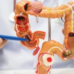 « Mars Bleu », mois de sensibilisation au dépistage du cancer colorectal : 180 à 200 nouveaux cas par an en Martinique 