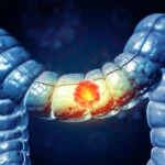 Peu d'Américains savent que cet aliment augmente le risque de cancer du côlon