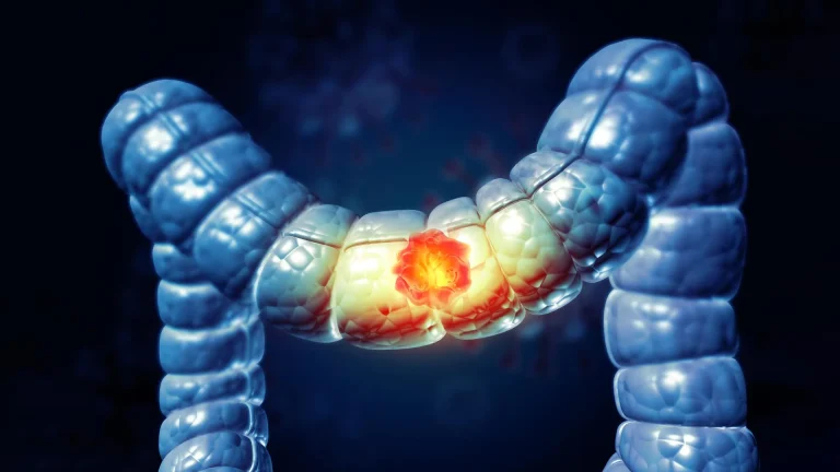 Peu d'Américains savent que cet aliment augmente le risque de cancer du côlon