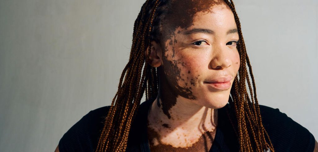 Une jeune femme ayant un vitiligo, maladie auto-immune.