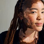 Une jeune femme ayant un vitiligo, maladie auto-immune.